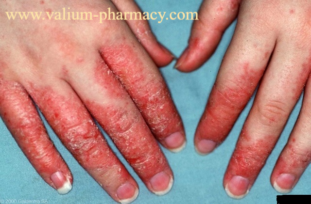 Penyakit Eczema Pada Bayi dan Pengobatannya